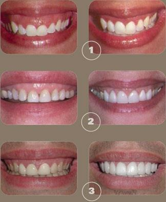 Crown Lengthning