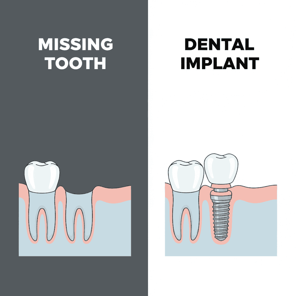 Dental Implants