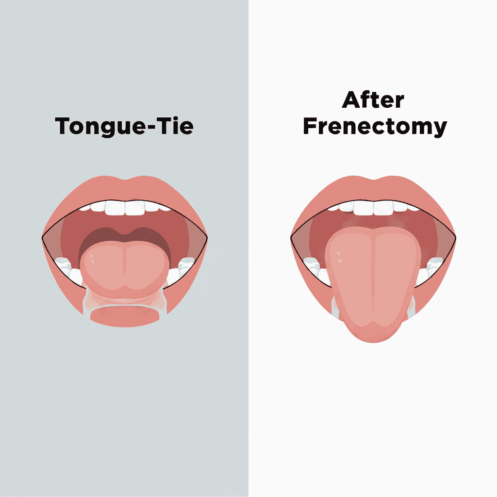 Frenectomy