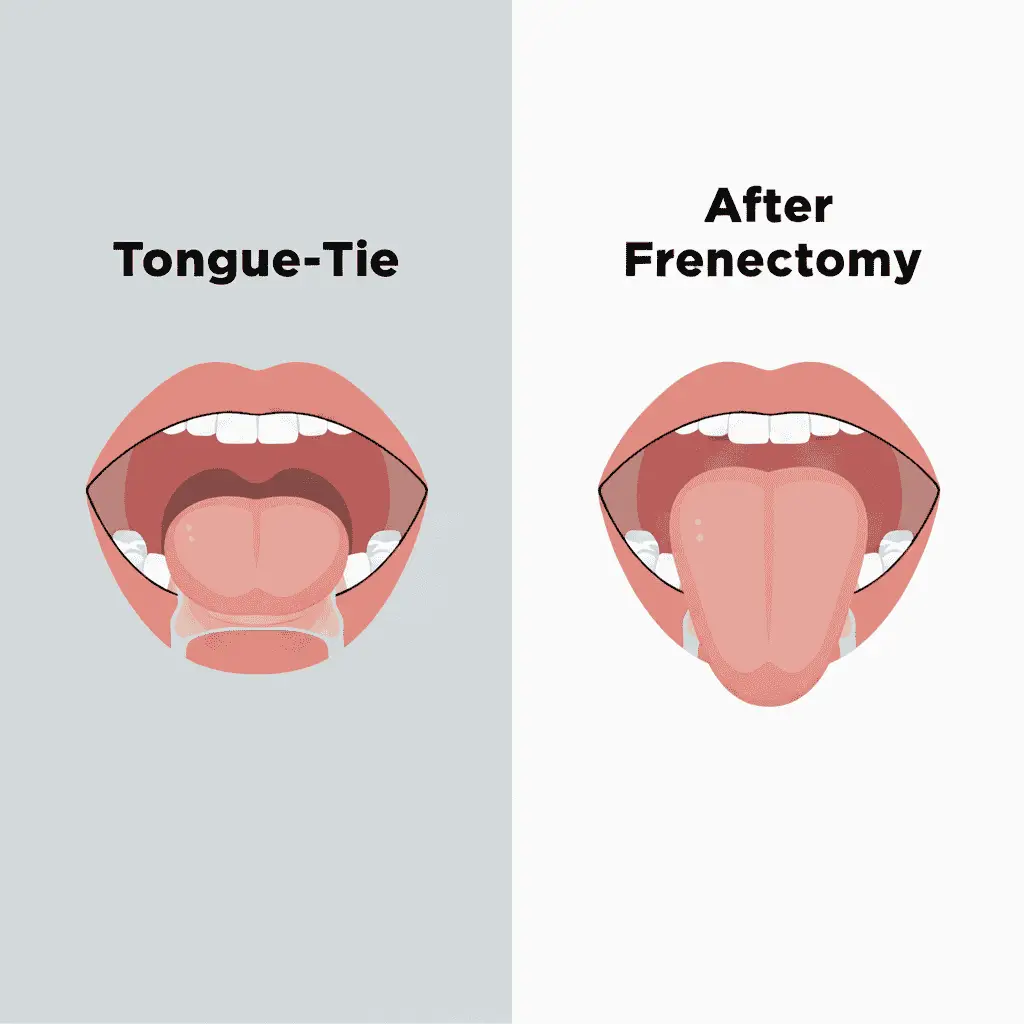 Frenectomy Frenectomy