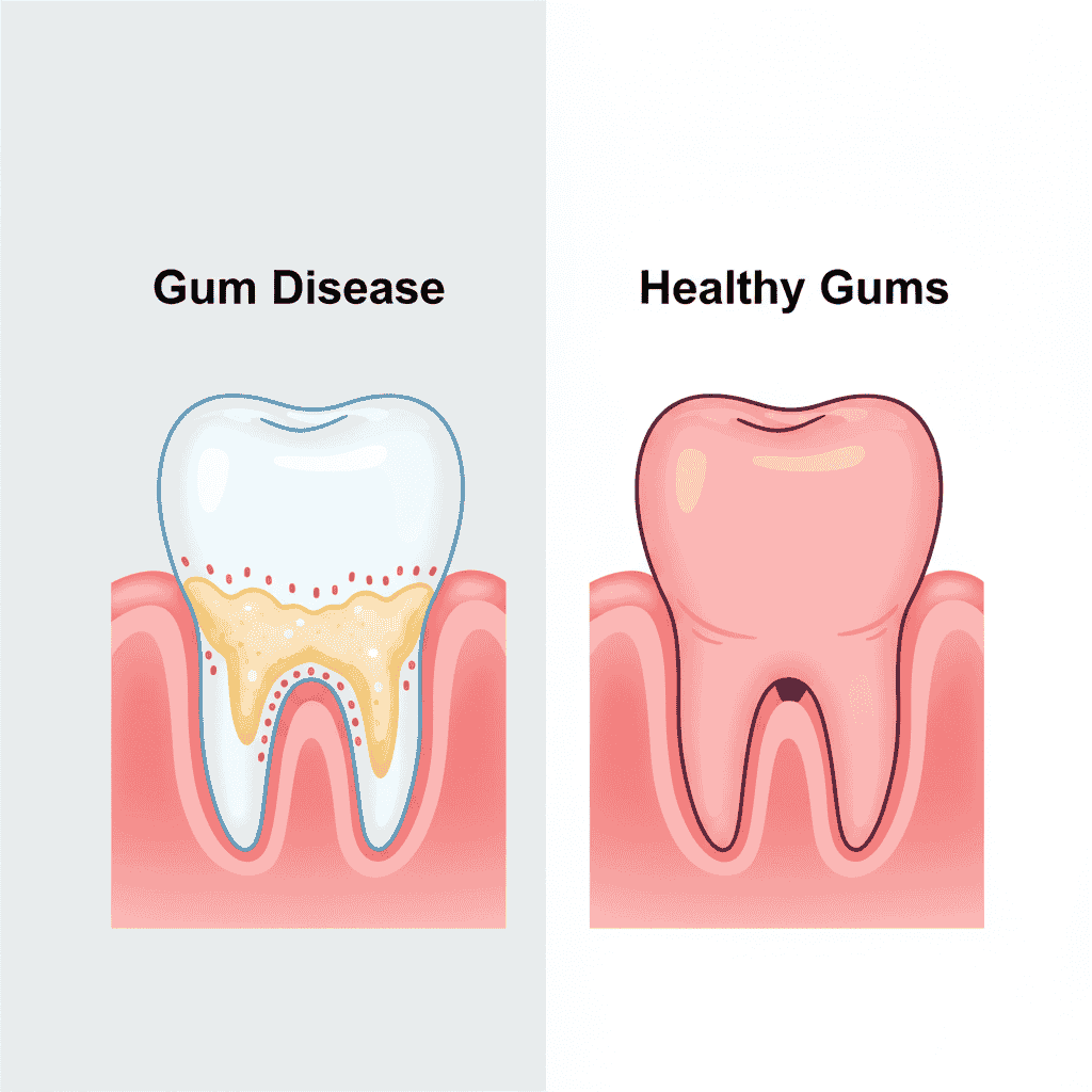 Gum Deisease