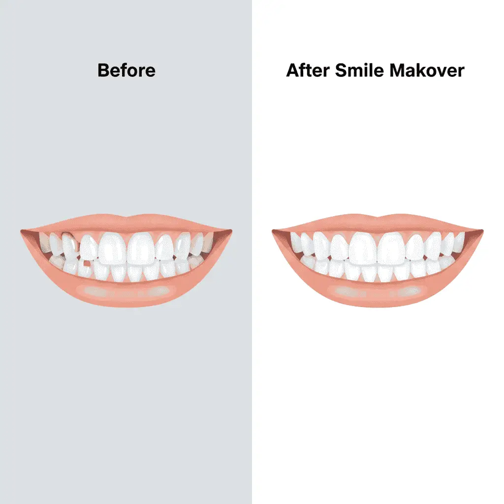Smile Makeover Smile Makeover