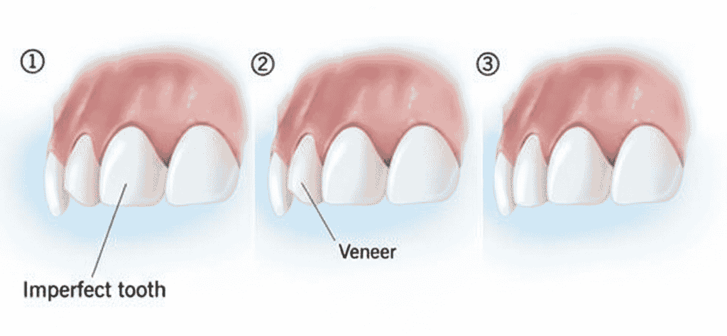 Venners