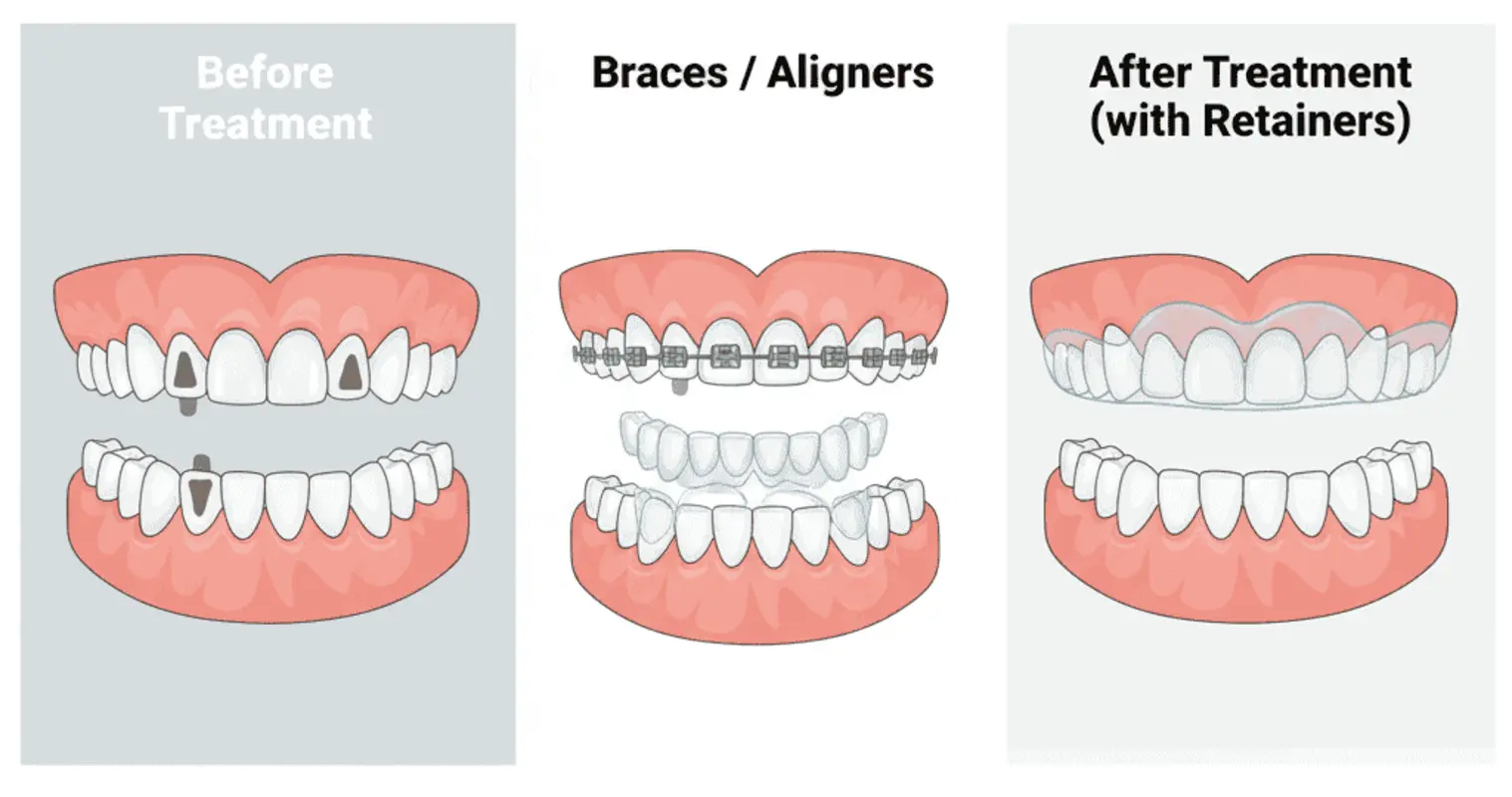 Cosmetic Dentistry in Hyderabad- Braces and Aligners